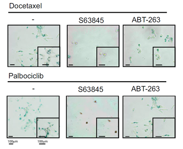 A new senolytic selectively kills therapy -induced prostate cancer senescent cells