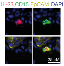 Representative images of MDSCs within the tumors of patients with CRPC